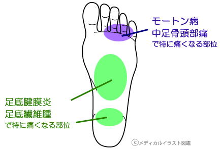 足底腱膜炎 足裏の痛み 新宿で整体なら 新宿整骨院 夜間 21時迄 土日祝営業